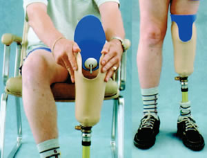 The primary drawback of sleeve suspension is that even a pinhole leak will eliminate the suction effect, and sleeves wear out after a few months. For this reason, two or three sleeves are usually provided initially and then replaced as they abrade (wear away) or tear from normal use. Another common complaint is that the external sleeve limits maximum knee flexion, although this restriction can be minimized by careful attention to socket trim lines and selection of a sleeve made from one of the more elastic materials. Some people complain of a “pulling sensation” or irritation at the top edge of the sleeve, but this can usually be eliminated by the application of a small amount of skin lubricant such as A&D Ointment. Sleeve suspensions are also difficult for people with a very tapered thigh since the cone-shaped musculature tends to force the sleeve to roll down the leg. Roll-On Liners Another common method of creating a vacuum seal against the skin is the use of a roll-on elastomeric liner that fits inside the socket. The original concept was to use a very thin silicone membrane that rolled on directly against the skin in place of textile limb socks, called a “Silicone Suction Socket,” “3S,” or “Iceross” (Icelandic Roll-On Suction Socket). The distal end of the roll-on liner is usually tethered to the bottom of the socket by a cord or strap (lanyard) or by a protruding pin that slides into a shuttle lock built into the prosthesis. This method of suspension has proven to be very convenient and easy to use and is therefore quite commonly used. To remove the prosthesis, the amputee presses a small button to release the lock or unfastens the strap or cord. One advantage of the roll-on liner is that knee flexion is less restricted than with an external sleeve. Another is that the liner material protects the skin against shear forces. If the residual limb loses volume due to weight loss or atrophy, the amputee can apply limb socks over the outside of the liner to compensate. It is also possible to use a somewhat thicker liner made from a gel material that adds cushioning (sometimes called a “gel locking liner”), as shown in Figure 2. Another suspension variant combines the sleeve with the cushion liner and adds a small mechanical pump that increases the vacuum with every step. Preliminary data suggests that such augmented suction may reduce the normal fluctuations in the volume of the mature residual limb, although why this may be so has not been established. If the residual limb volume is more constant, then the prosthesis should fit more precisely throughout the day, so this may prove to be an advantage of augmented vacuum systems. Figure 3 shows one example of this suspension system. Hypobaric Seals Another method to create a relative vacuum in the socket is the use of a hypobaric seal that is incorporated into the limb socks or into the cushion liner in combination with an expulsion valve. With these methods, only the lower portion of the socket forms the vacuum chamber. Figure 4 shows an example of a suspension based on a hypobaric seal.