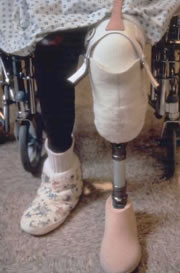 Transtibial Suspension 06