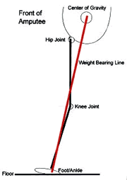 Fitting for Hip Disarticulation IMG 01