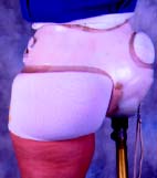 Fitting for Hip Disarticulation IMG 07