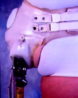 Fitting for Hip Disarticulation IMG 08