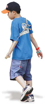 Congenital Limb Deficiencies and Acquired Amputations in Childhood