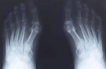 Painful Neuropathy Spanis IMG 01