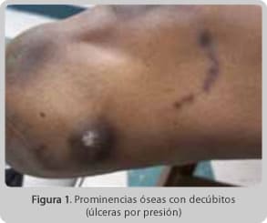 Identificación y control de problemas cutáneos con el uso de prótesis en extremidades inferiores