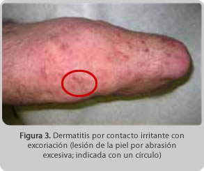Identificación y control de problemas cutáneos con el uso de prótesis en extremidades inferiores IMG 03