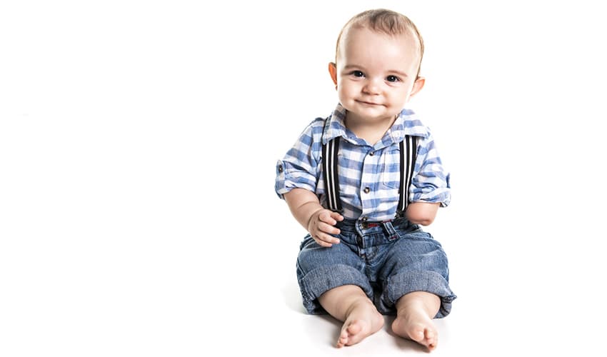 Deficiencias congénitas de extremidades y amputaciones en la infancia