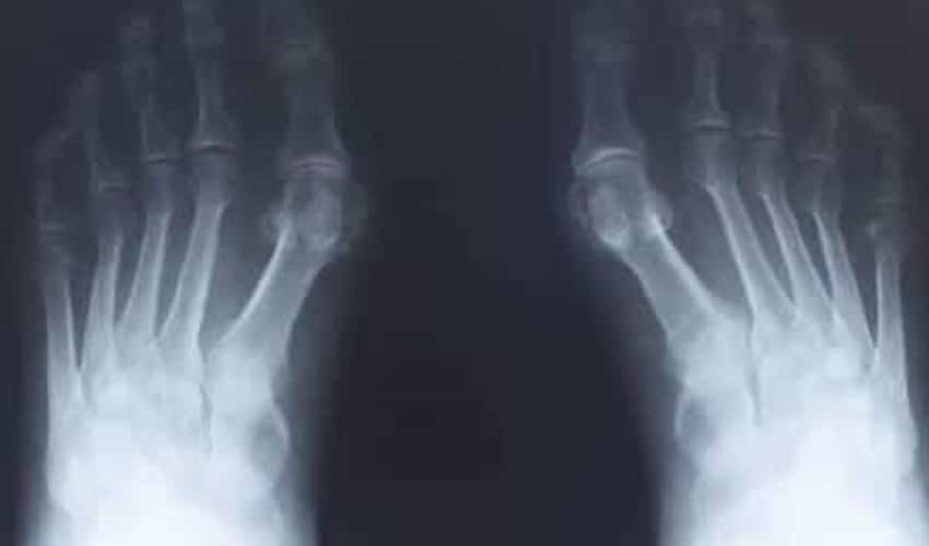 Cómo afrontar la dolorosa neuropatía periférica